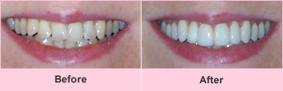 Cosmetic dentistry