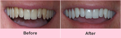 Whitening Whitening