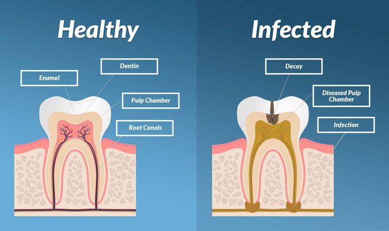 Healthy versus infected tooth diagram