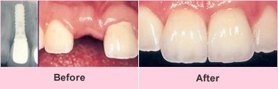 Dental implant before and after