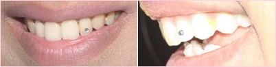 Tooth jewellery before and after