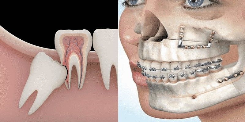 Impacted wisdom tooth and jaw surgery diagram