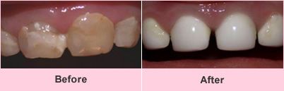 Pediatric filling before and after