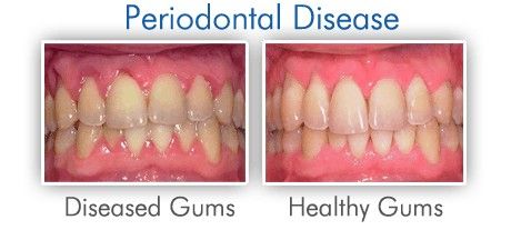 Diseased versus healthy gums