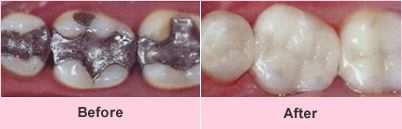 Restorative dentistry before and after
