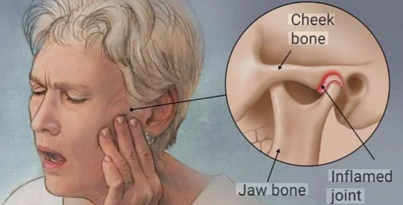 TMJ jaw pain diagram