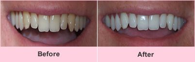 Teeth whitening before and after